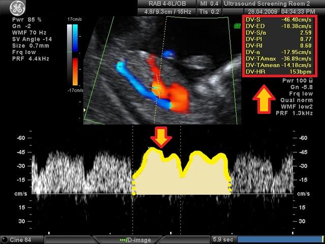 Badanie USG ultrasonografem - Przepływ krwi w przewodzie żylnym (DV)