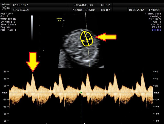 Badanie USG ultrasonografem - Przepływ krwi przez zastawkę trójdzielną (TR)