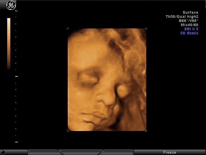 Badanie USG 3/4D - widok z ultrasonografu