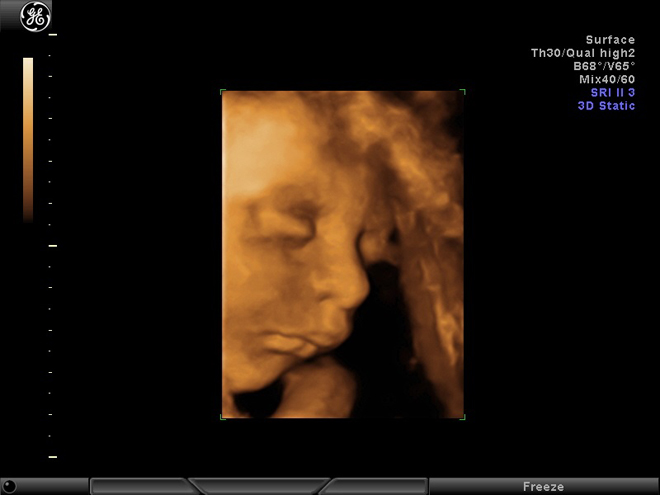 Badanie USG 3/4D - widok z ultrasonografu